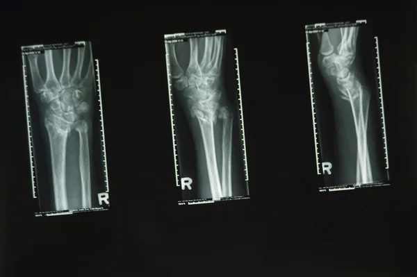 Three X-Rays Of A Wrist — Stock Photo, Image