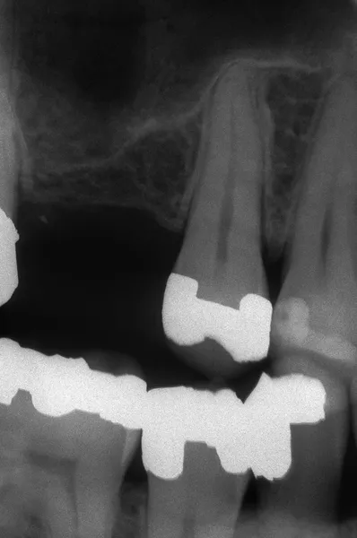 Dental röntgen — Stockfoto