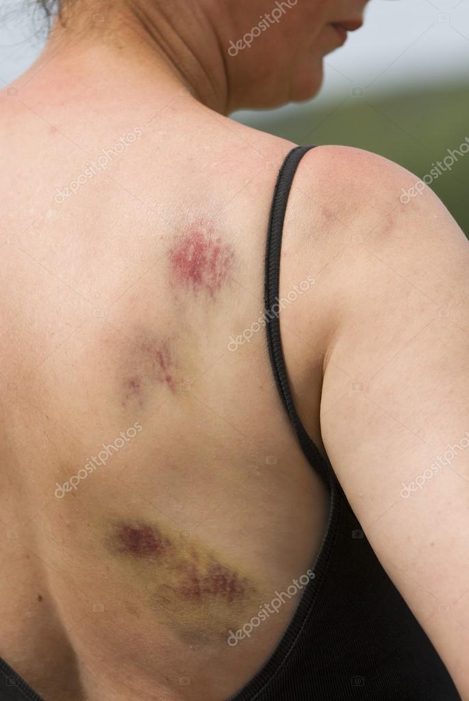 Bruising On Woman's Right Shoulder And Back Stock Photo by