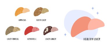 Sağlıklı karaciğer. Hastalıklar: siroz, yağ, fibroz, hepatit c, kanser. Hepatoloji. Vektör düz çizgi film çizimi. Tıbbi broşür ve broşür için mükemmel.