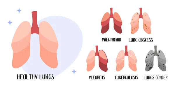 健康的肺 呼吸系统 肺脓肿 胸膜炎 肺结核 肺病学 矢量平面卡通画 完美的医疗传单 小册子 — 图库矢量图片