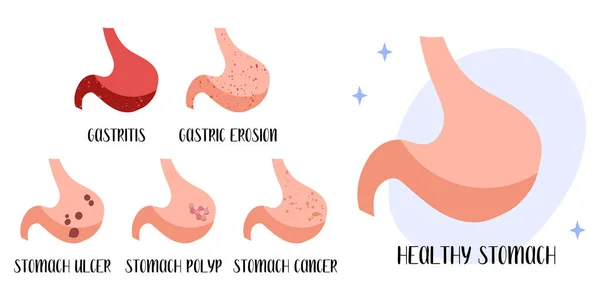 Frisk Mage Sjukdomar Gastrit Magerosion Sår Cancer Polyp Gastroenterologi Vektor — Stock vektor