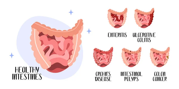 Intestinos Saudáveis Intestino Doenças Enterite Colite Ulcerosa Doença Crohn Pólipo —  Vetores de Stock