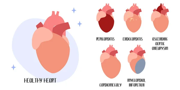 Gesundes Herz Herz Kreislauf Erkrankungen Perikarditis Endokarditis Myokardinfarkt Kardiomegalie Aneurysma — Stockvektor