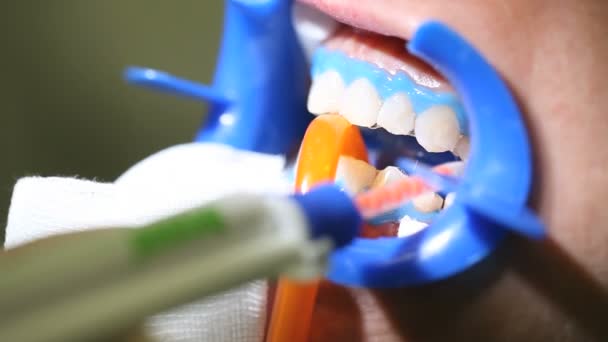 Dentist dental cleaning, whitening