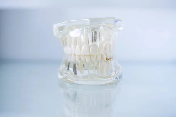 Набор Вставных Зубов Стоматологической Клинике Белом Отражающем Фоне — стоковое фото