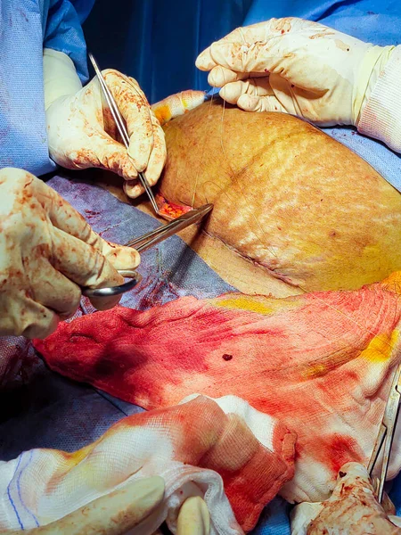 Зашивание Хирургической Раны После Кесарева Сечения — стоковое фото