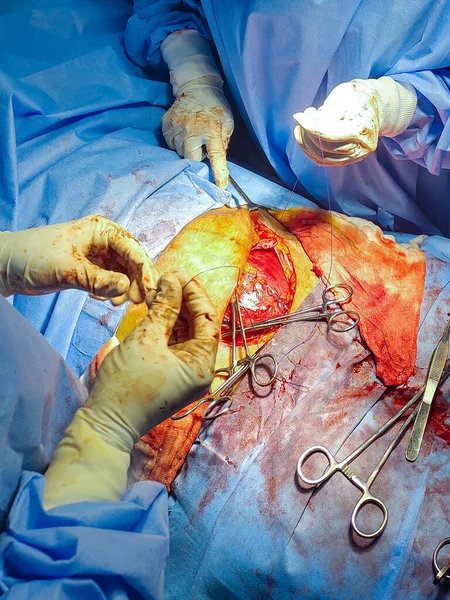 Sluiting Van Een Chirurgische Wond Bevalling Door Een Keizersnede — Stockfoto