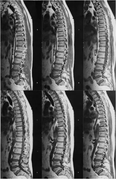 Nuclear Magnetic Resonance Imaging Entire Spine Lateral View — Stock Photo, Image