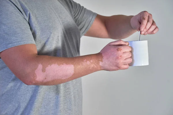Mans Hand Med Vitiligo Missfärgning Sjukdom Som Håller Kopp Kaffe — Stockfoto