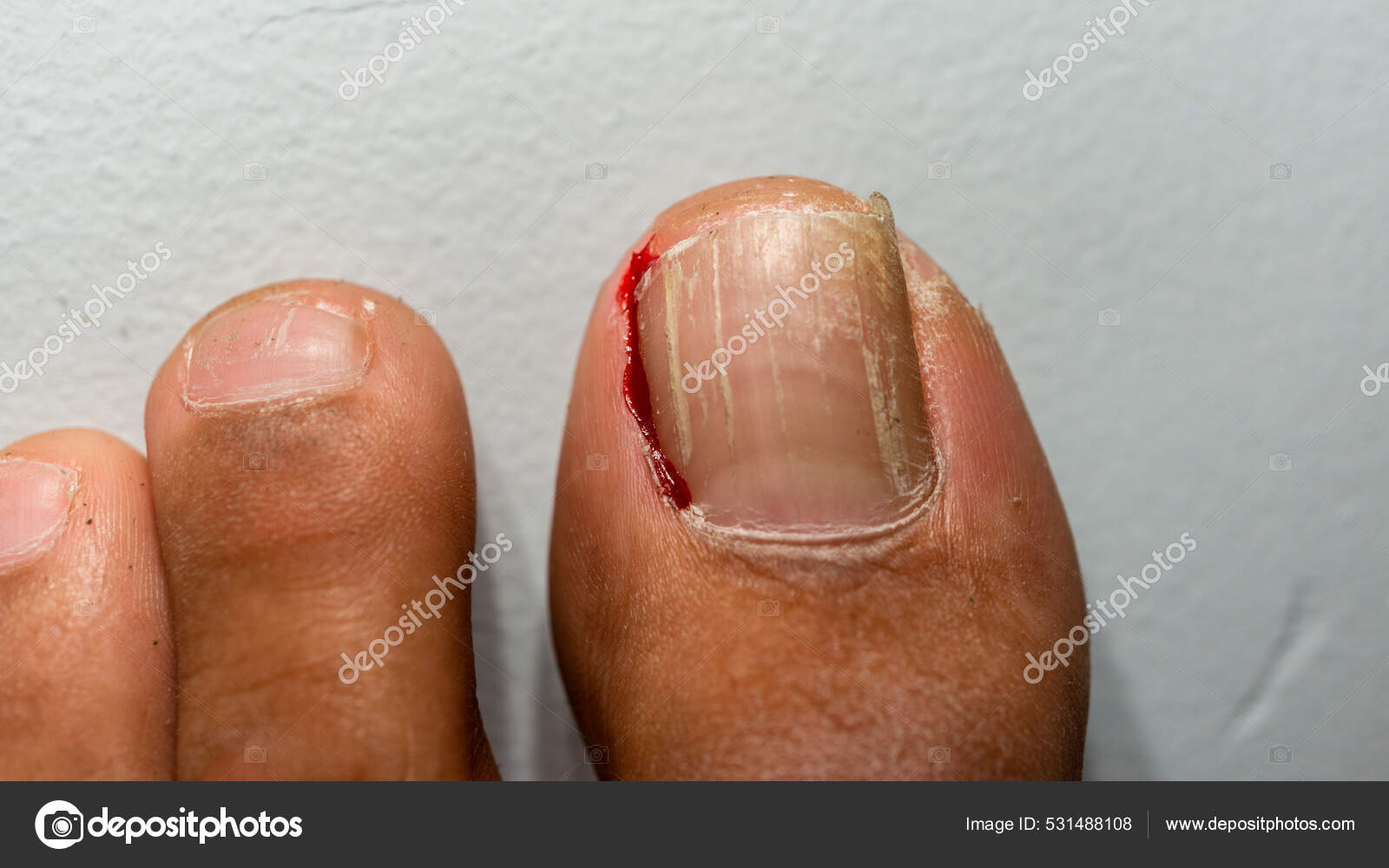 Ingrown Toe Nail Causing Bleeding image libre de droit par Wirestock