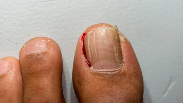 Ingrown Toe Nail Causing Bleeding — стоковое фото