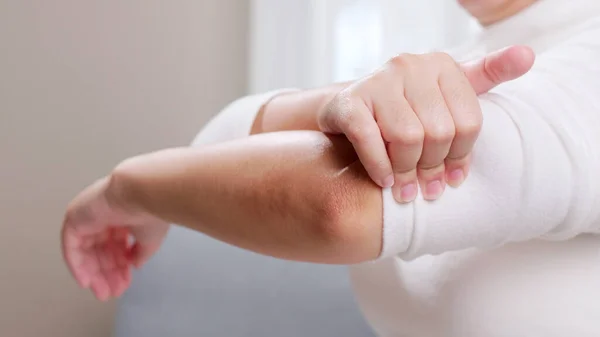 Young Woman Having Pain Her Elbow Using Hand Self Massage — Fotografia de Stock