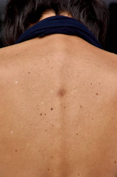 Mature Woman Skin Spots Moles Her Back — Stock Photo, Image