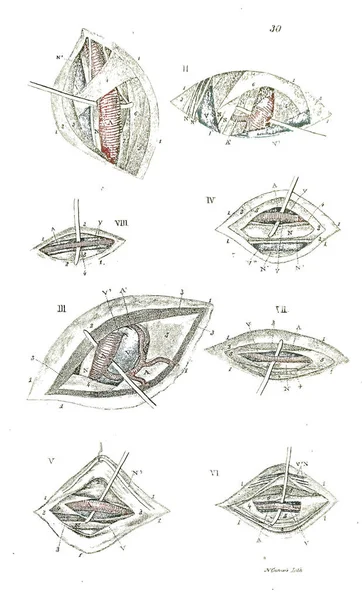 Illustrazione Bianco Nero Del Processo Operazione Libro Testo Anatomico Ottocentesco — Foto Stock