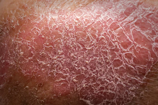 Extrem Skott Hud Med Psoriasis Armbågen — Stockfoto