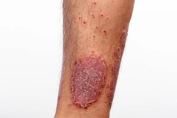 Rash on elbow Stock Photos, Royalty Free Rash on elbow Images ...