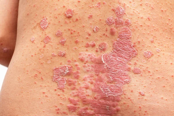 Psoriasis Att Tillbaka Vit Bakgrund — Stockfoto