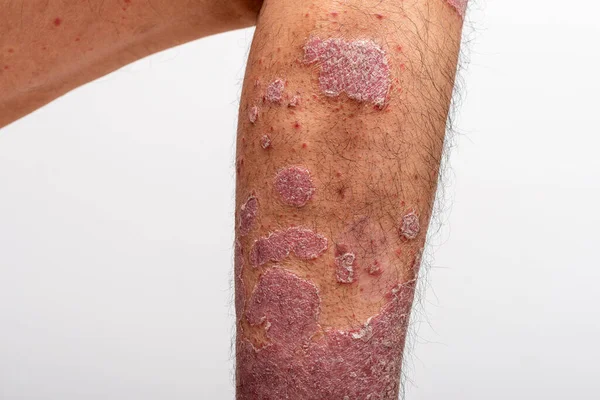 Psoriasis Att Knä Vit Bakgrund — Stockfoto