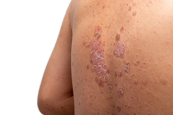 Psoriasis Att Tillbaka Vit Bakgrund — Stockfoto