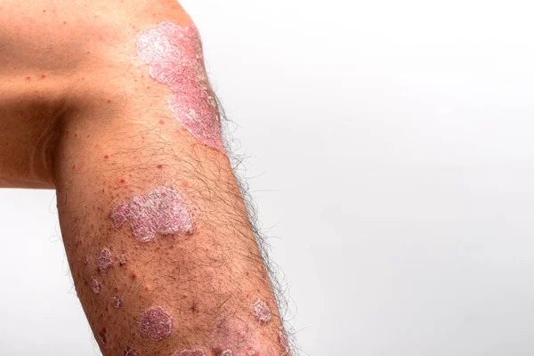 Psoriasis Att Knä Vit Bakgrund — Stockfoto