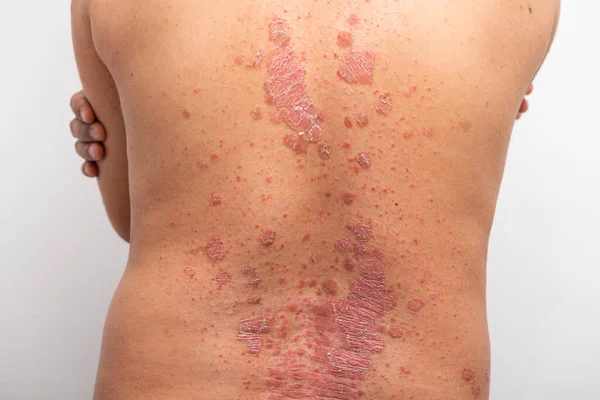 Psoriasis Att Tillbaka Vit Bakgrund — Stockfoto