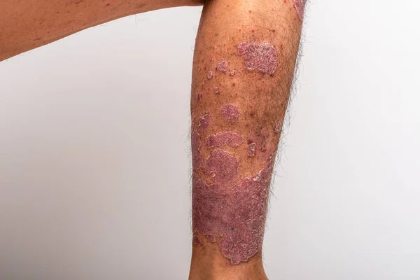 Psoriasis Esa Rodilla Sobre Fondo Blanco Fotos de stock