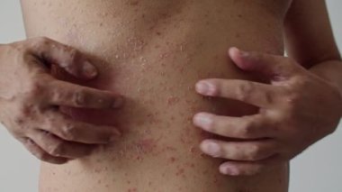 Psoriasis is the abdomen on white background. 4K Slow Motion