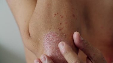 Psoriasis is that elbow on white background. 4K Slow Motion