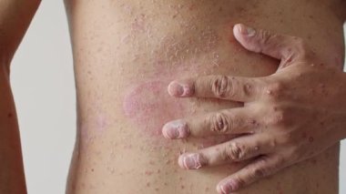 Psoriasis is the abdomen on white background. 4K Slow Motion