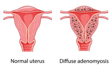 Yaygın Adenomyosis İnsan Anatomisi Kadın Hastalığı normal üreme sistemi organlarına karşı. Konum Çapraz kesit şeması rahim