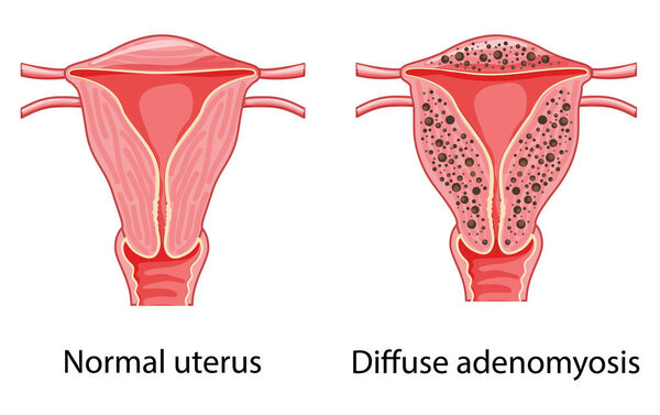 Diffuse Adenomyosis Human anatomy Female Sick vs normal reproductive system organs. Location Cross section scheme uterus