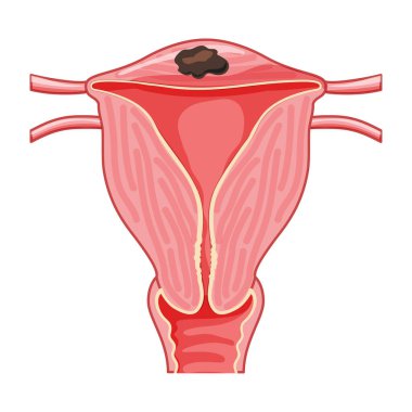 Odak Adenomyosis İnsan Anatomisi Kadın Üreme Hastalığı Sistemi, Organları. konum şeması rahim simgesi. Vektör 