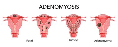 Adenomiyozis hastalığı seti - odaksal, dağınık ve adenomyoma üreme sistemi, organlar. İnsan anatomisi konumu 