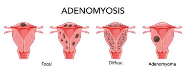 Adenomyosis illness set - focal, diffuse and adenomyoma Female reproductive system, organs. Human anatomy location  clipart