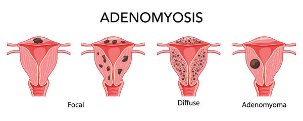 Adenomyosis illness set - focal, diffuse and adenomyoma Female reproductive system, organs. Human anatomy location 