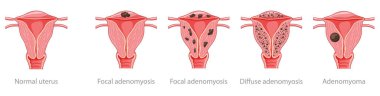 Adenomyosis Focal, Diffuse, Adenomyoma ve normal uterus İnsan Anatomisi Kadın Üreme Hastalığı Sistemi, organ ikonu