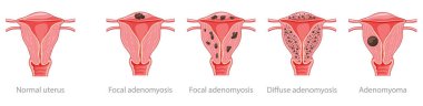 Adenomyosis Focal, Diffuse, Adenomyoma and normal uterus Human anatomy Female reproductive Sick system, organs icon clipart