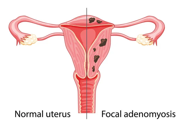 Adénoomyose focale Anatomie humaine Appareil reproducteur féminin Maladie vs normale Comparaison éducation saine — Image vectorielle