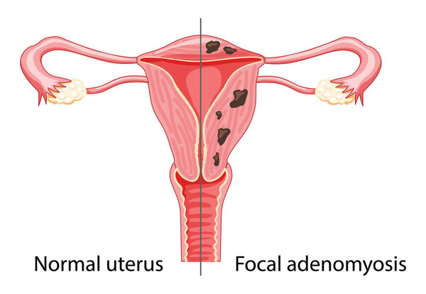 Focal Adenomyosis Human anatomy Female reproductive Sick system vs versus normal Compared educational healthy 