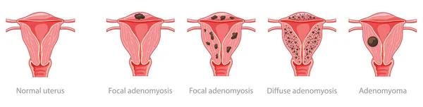 Adénomyose Focale, diffuse, adénomyome et utérus normal Anatomie humaine Appareil reproducteur féminin Maladie, icône des organes — Image vectorielle
