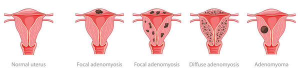 Adenomyosis Focal, Diffuse, Adenomyoma and normal uterus Human anatomy Female reproductive Sick system, organs icon