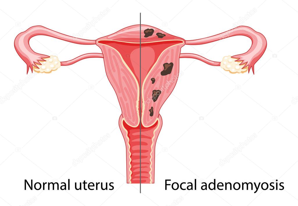 Focal Adenomyosis Human anatomy Female reproductive Sick system vs versus normal Compared educational healthy 