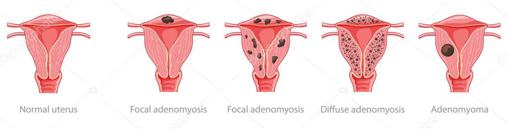 Adenomyosis Focal, Diffuse, Adenomyoma and normal uterus Human anatomy Female reproductive Sick system, organs icon