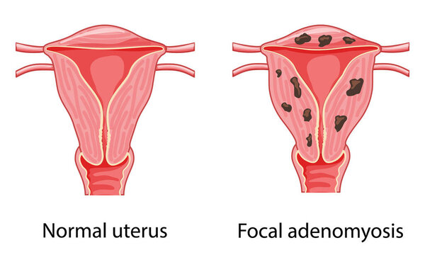 Adenomyosis Focal Human anatomy Female reproductive Normal and Sick system organs. Location scheme uterus vagina icon. 