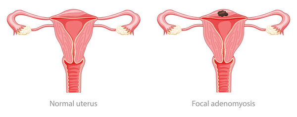 Focal Adenomyosis Human anatomy Female Sick and normal reproductive system organs. Location scheme Cross section icon