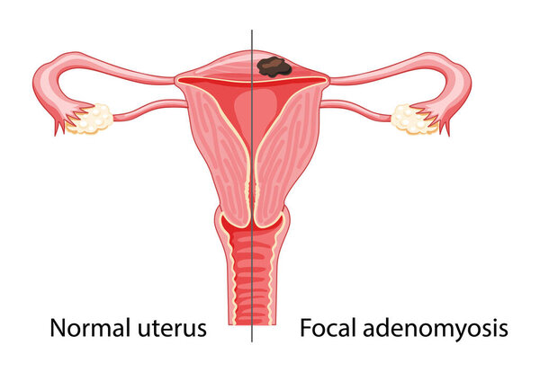 Adenomyosis Focal Human anatomy Female reproductive Sick system vs versus normal Compared educational healthy abnormal