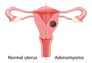 Adenomyoma Adenomyosis Human anatomy, Female reproductive Sick system versus normal. Compared educational healthy icon clipart