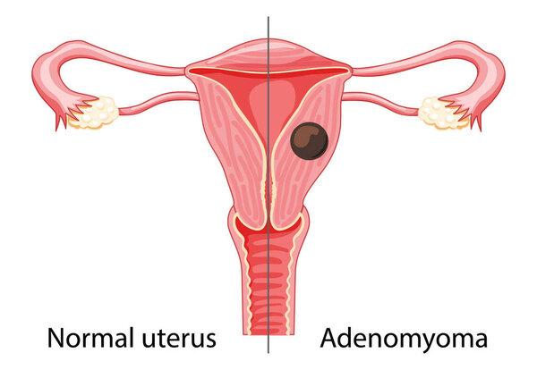 Adenomyoma Adenomyosis Human anatomy, Female reproductive Sick system versus normal. Compared educational healthy icon