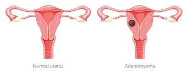 Adenomyoma Adenomyosis İnsan Anatomisi Kadın Hastalığı ve normal üreme sistemi organları. Konum şeması kesiti 
